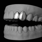 Winow Grillz Set on Canine and Incisor